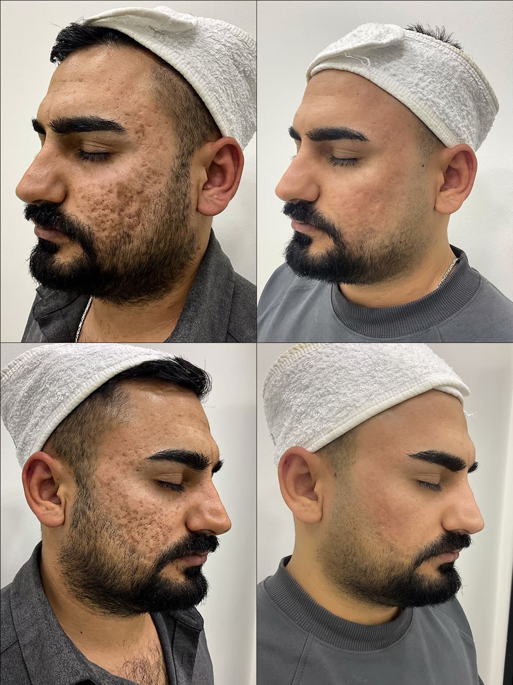 Akne & Scar (İz) Görünümü