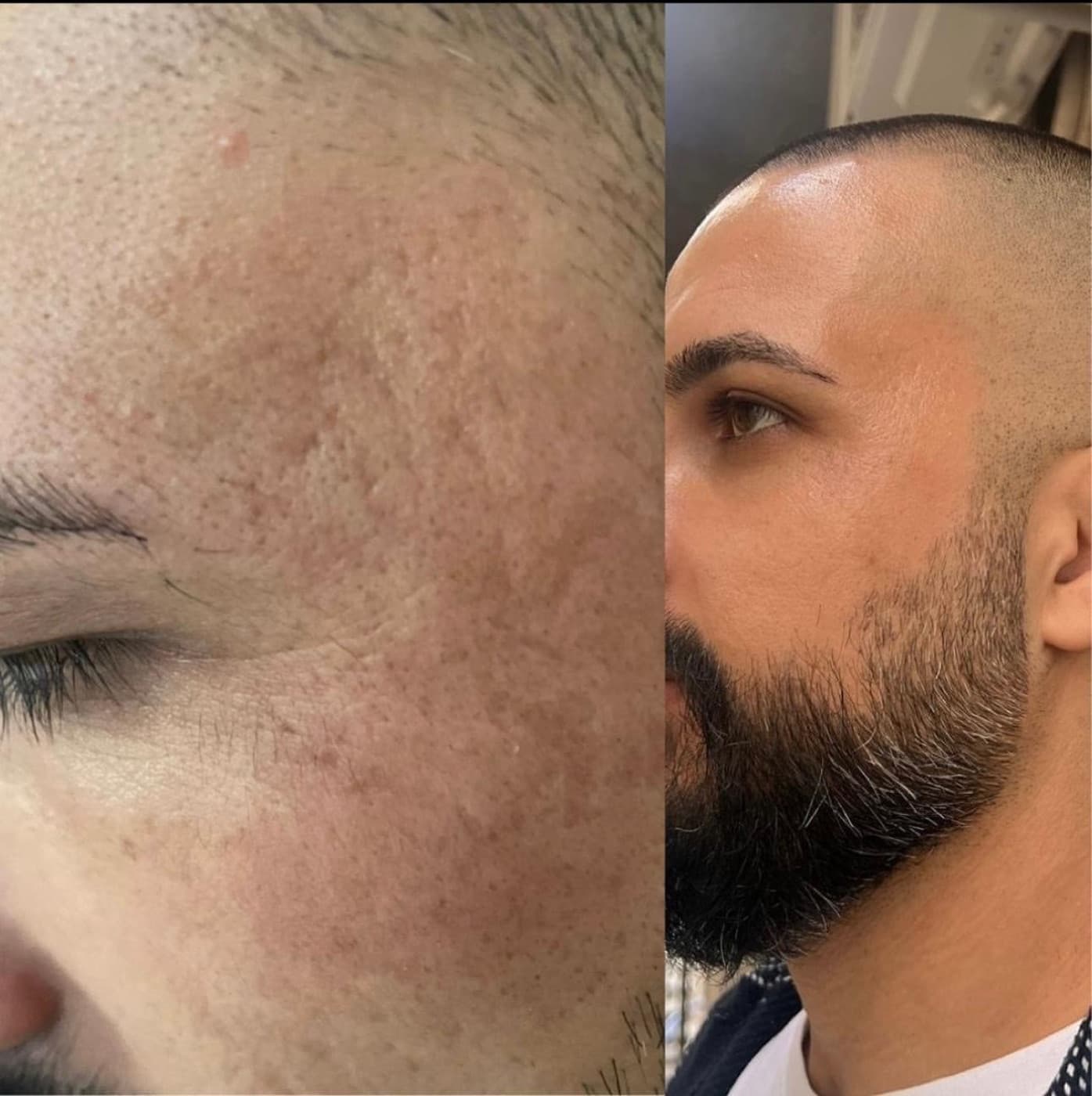 Akne sonrası iz görünümü: MoonQueen bakım süreci öncesi ve sonrası