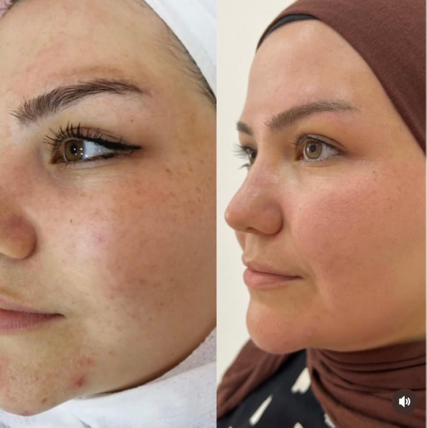 Cilt dokusu ve iz görünümü: MoonQueen bakım süreci öncesi ve sonrası